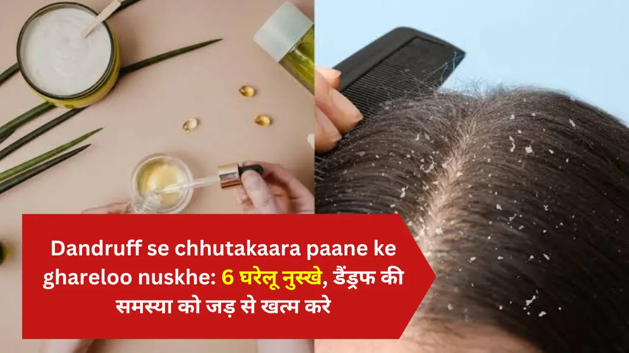 Dandruff se chhutakara paane ke ghareloo nushke